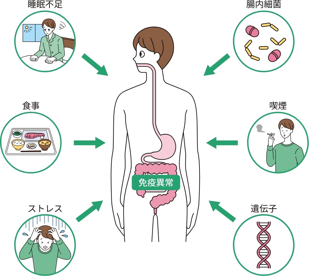 クローン病の発症のさまざまな要因