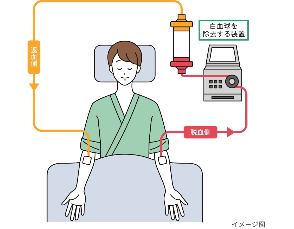 血球成分除去療法のイメージ図